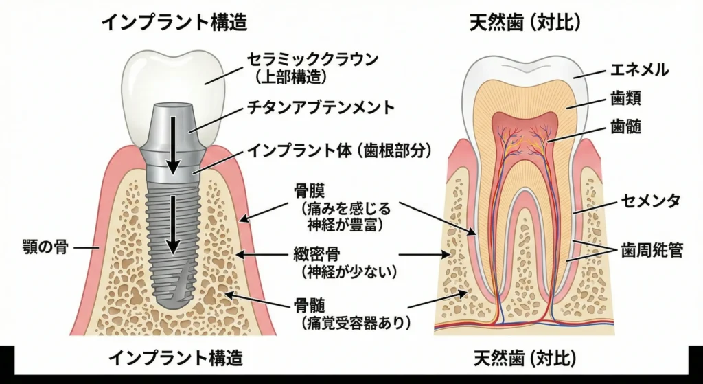 インプラントの構造