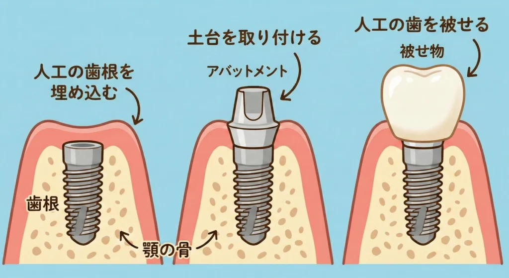 インプラント治療とは